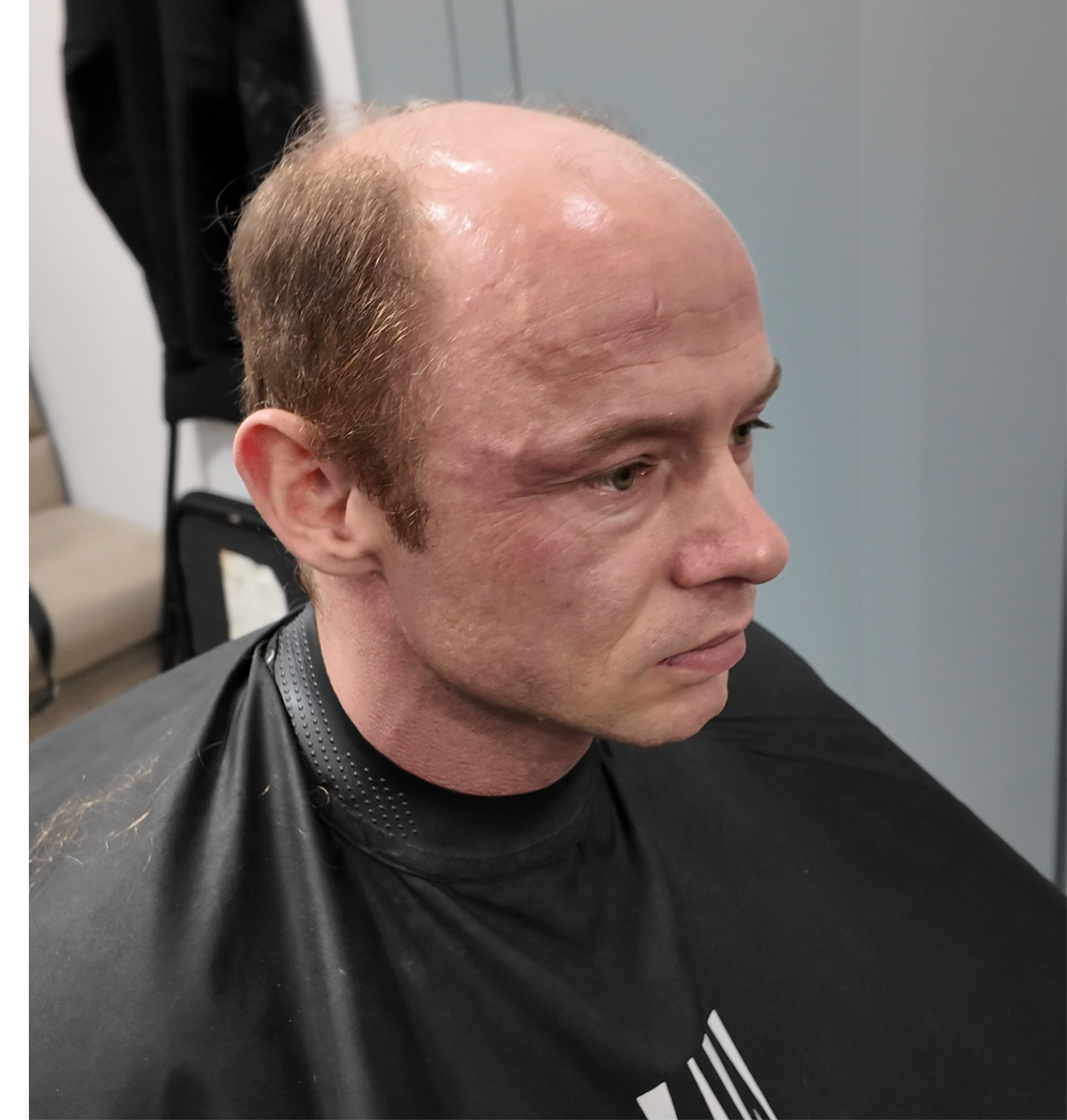 Piotr przed montażem systemu włosów, widok z przodu
