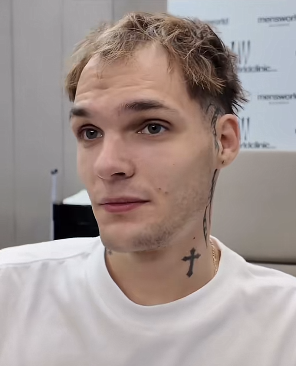 Leszek przed montażem systemu włosów